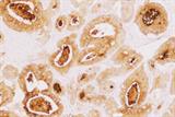 CEA antibody stain: tumour marker for colon cancer (Photograph: SPL)