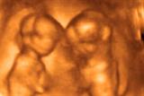 Twin foetuses ultrasound scanning is routine during pregnancy (Photograph: SPL)