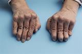 Deformed fingers of the hands in an elderly female patient with rheumatoid arthritis (Photograph: SPL)