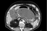 CT showing acute pancreatitis and peri-pancreatic fluid collection