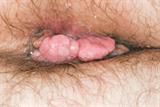 Anogenital warts are mainly a cosmetic problem but can cause patients psychological distress (Photograph: SPL)