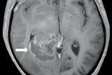 T1 MRI showing tumour