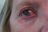 Blepharitis may be due to MGD