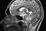 Tumours such as brain stem glioma may be detected by an MRI scan