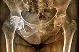 There are more than 300,000 fragility fractures a year in the UK, and hip fractures alone cost £2 billion (Photograph: SPL)