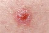 Basal cell carcinoma (Photograph: SPL)