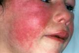 Most scarlet fever cases are in children under 10 (photo: SPL)