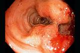 Colorectal cancer is the second most common cause of cancer death. Pic: SPL