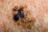 Low oxygen levels in the blood are thought to accelerate malignant melanoma growth (DR P. MARAZZI/SCIENCE PHOTO LIBRARY)