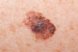 Malignant melanoma 10-year survival rates have leapt from 46 to 89 per cent over the past four decades (photo: Dr P Marazzi/SPL)