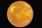 Macular degeneration: treatment row (photo: SPL)