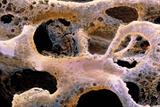 Osteoporotic bone (Photograph: Professor P Motta)