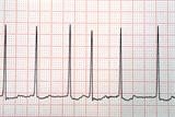 AF is a form of arrhythmia affecting the upper chambers of the heart combined with heart failure (Photograph: SPL)