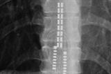 Plain AP X-ray showing the position of the spinal-cord stimulating electrode 