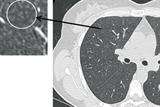 HRCT of the chest in acute hypersensitivity pneumonitis showing widespread centrilobular nodules