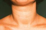 Goitre in hypothyroidism