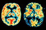 Scan of a normal brain (left) and AD patient (right). Blue/black areas show reduced brain activity (Photograph: SPL)