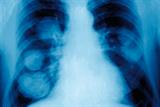 Chest X-ray revealed metastases (Photograph: SPL)