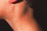 Anterior cervical lymphadenopathy is a symptom of tonsillitis (Photograph: SPL)