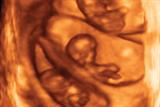 3D ultrasound scan showing triplets (Photograph: SPL)