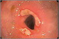 Ulcer: a scab in the colon of a patient with colitis