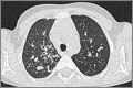 CT chest scan in severe asthma: bronchiectasis is seen bilaterally