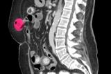 Abdominal wall hernia (red): palpate the hernial orifices