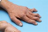 Rheumatoid arthritis: high cost (Photograph: SPL)