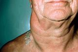 Lymphadenopathy is one of the most common presenting symptoms (Photograph: SPL)