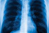 Routine chest X-rays to exclude lung cancer after recovery from pneumonia are not warranted (Photograph: SPL)