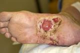 Diabetic foot ulcer: protein affects healing process (Photo: Science Photo Library)