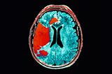 Stroke: women's quality of life affected more than men's (Photo: Science Photo Library)