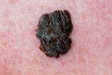 More than 10,000 cases of melanoma are diagnosed in the UK each year (Photograph: SPL)