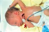 Patients with mild cases of HDN may have jaundice at birth (Photograph: SPL)