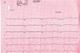 ECG to detect AF: new guidance proposes greater use of risk scores (Photo: Haymarket Medical)