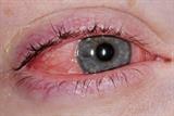 The patient presented with episodic allergic conjunctivitis (Photograph: SPL)