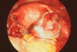 Laparoscopic view showing a polycystic ovary: PCOS is a leading cause of female subfertility (Photograph: SPL)