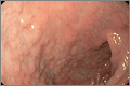 Endoscopic view: duodenal bulb