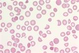 Microangiopathic haemolytic anaemia with red cell fragments and irregularly shaped red blood cells (Image: David Roberts and John Burthem)