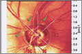 Thinning of the inferior and temporal neuroretinal rim