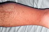 Prophylactic antibiotics may prevent recurrent cellulitis of the leg (Photograph: SPL)