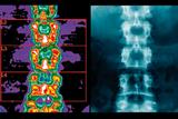 Vitamin D supplementation had a small effect on lumbar spine BMD (blue/purple: least dense areas) (Photograph: SPL)