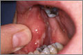 Oral pemphigus vulgaris. Photos: Kings College Hospital