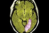 Stroke and other CV admission rates were lower with high HDL levels (Photograph: SPL)