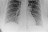 Erect chest radiograph demonstrating free gas under the diaphragm