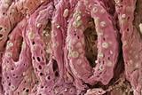 A scanning electron micrograph image of the bowel of a patient with ulcerative colitis (Photo: Steve Gschmeissner/SPL)