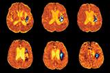 Stroke: patients with high BP faced higher risk of cardiovascular event (photo:SPL)