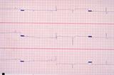 Hyperthyroidism causes tachycardia while hypothyroidism causes bradycardia (as shown)