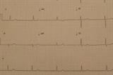 Junctional bradycardia: ECG shows absence of P waves and heart rate of 40bpm