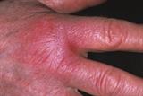 Cellulitis on the hand of a 65-year-old woman following a cat bite  (Photograph: SPL)